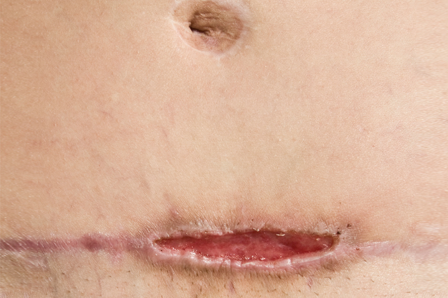 Incision after closure of the wound and application of surgical glue