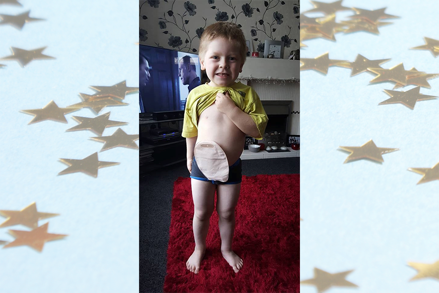 Little Boy Surprises Parents By Wearing Dad's Ostomy Bag to Be