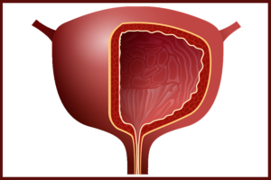 Bladder Condition