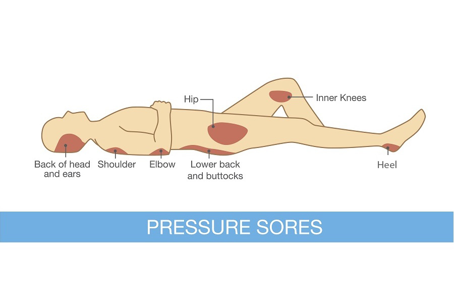 Pressure sores area